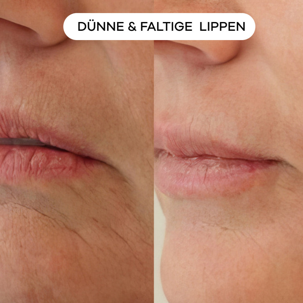 shinyface Micro Infusion System