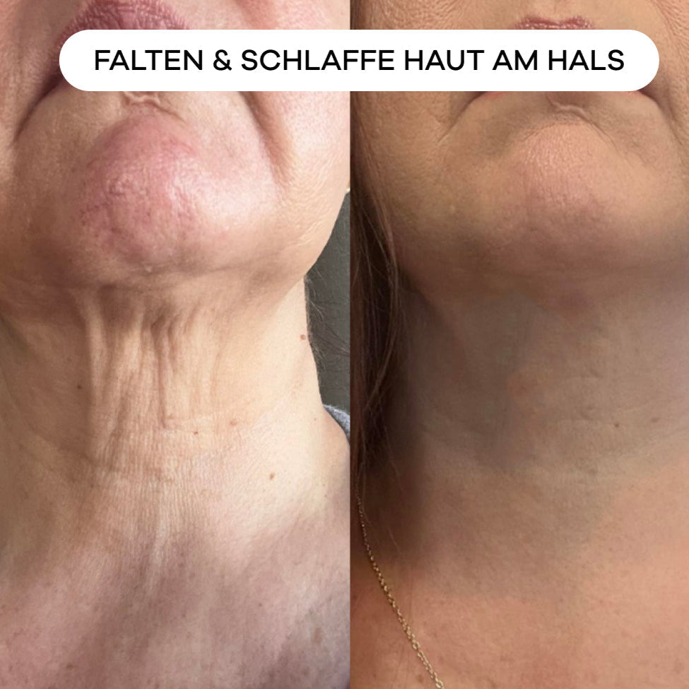 shinyface Micro Infusion System