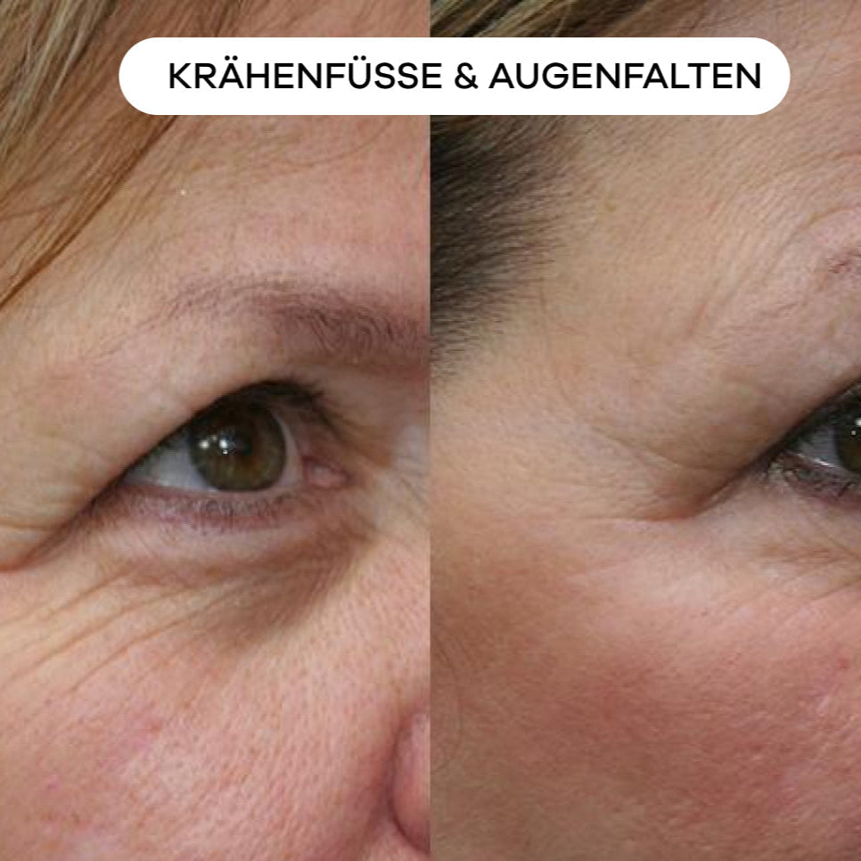 shinyface Micro Infusion System