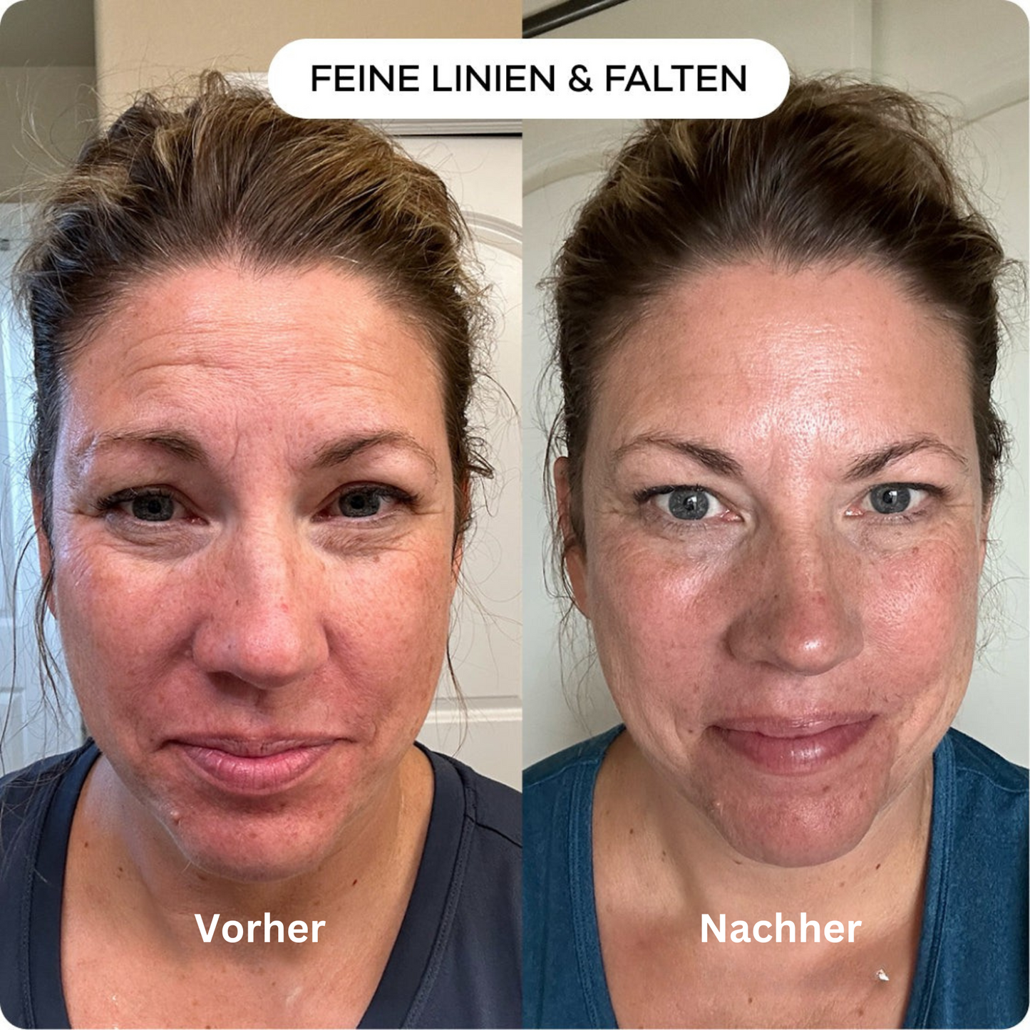 shinyface Micro Infusion System